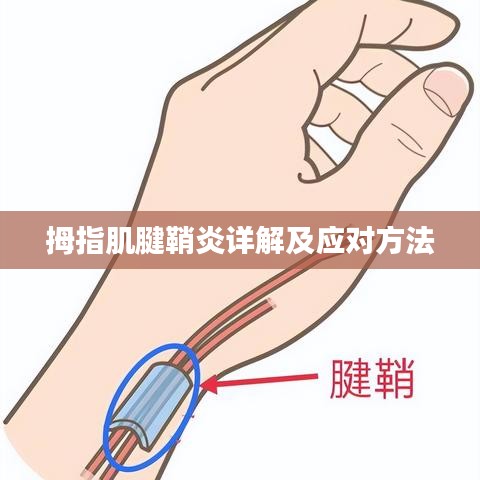 拇指肌腱鞘炎详解及应对方法